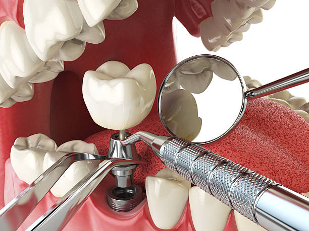 Best Emergency Dental Care for Broken or Chipped Teeth in Waverly, IL